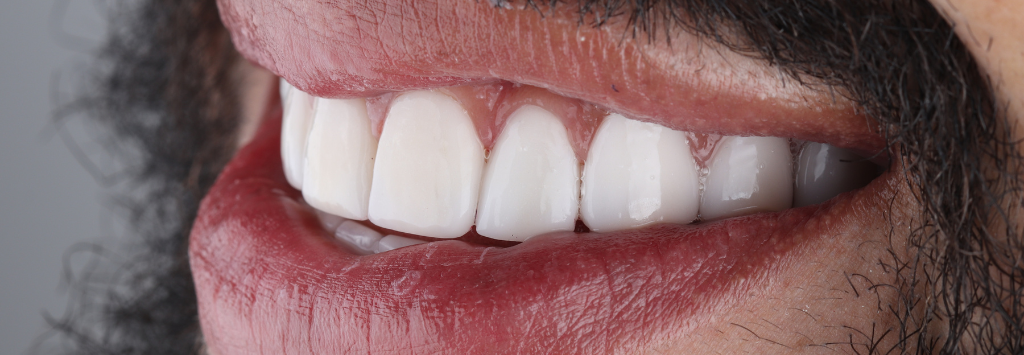 TopVeneers - Veneers in Colombia