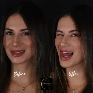 Veneers in colombia