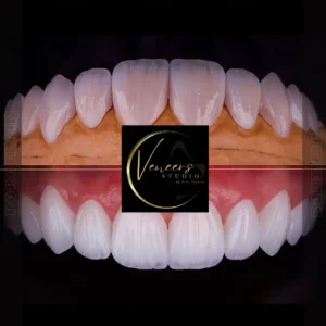 Veneers in colombia