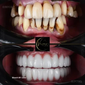 Veneers in colombia