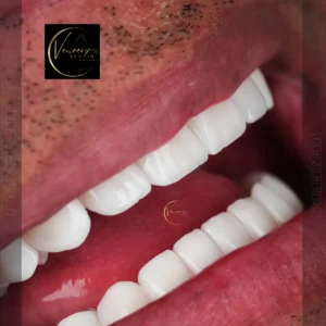 Veneers in colombia