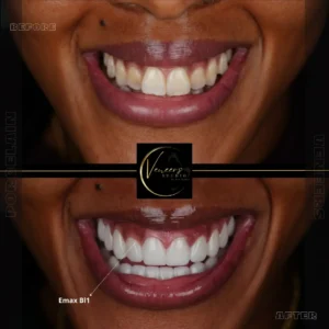 porcelain veneers